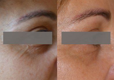 Rimozione rughe contorno occhi