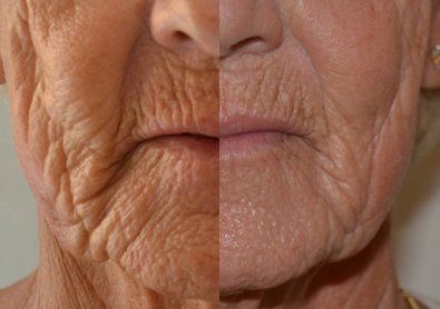 Trattamento anti age