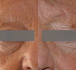 Trattamento contro l'invecchiamento della pelle