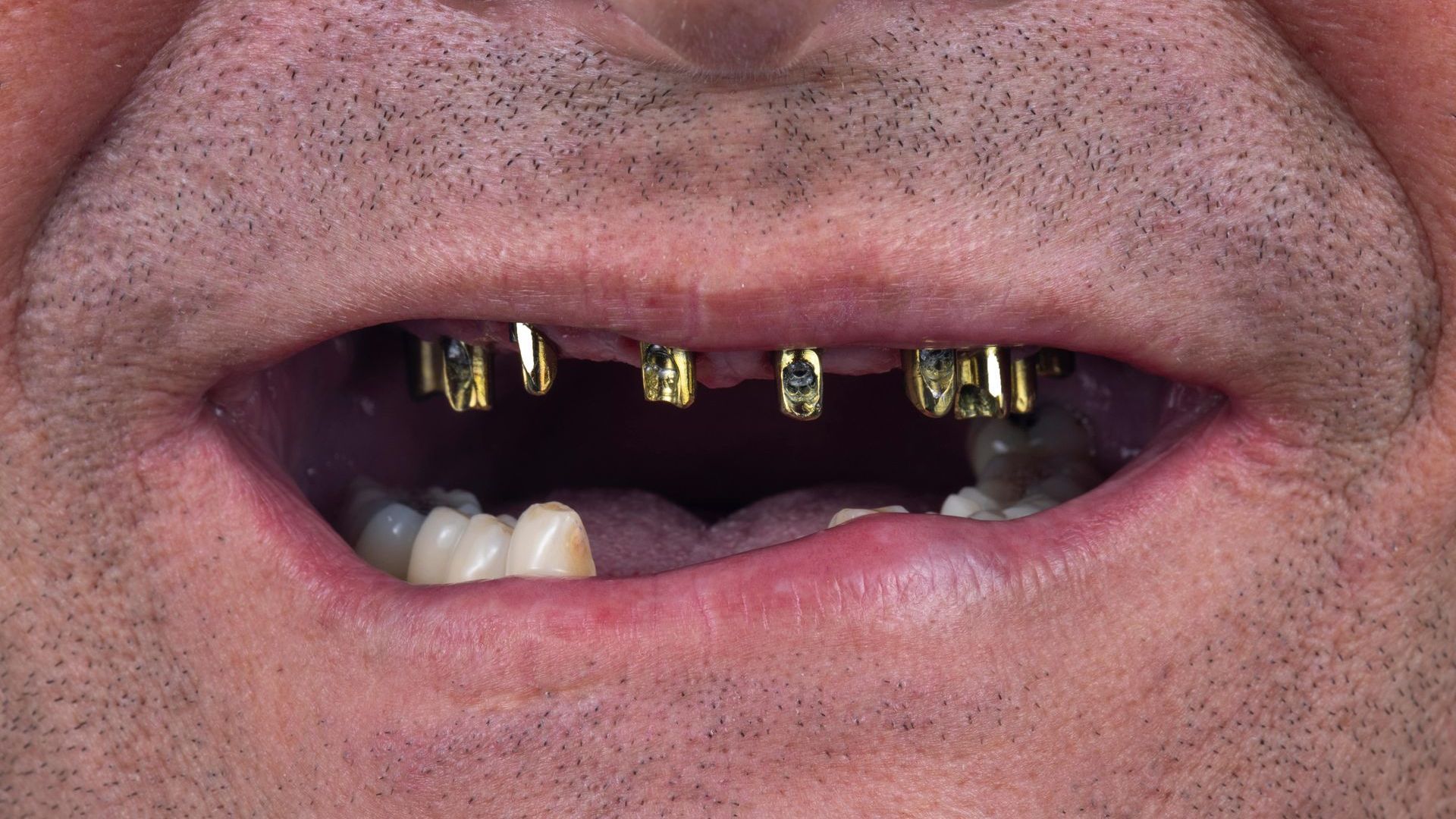 A close up of a man 's mouth with missing teeth.