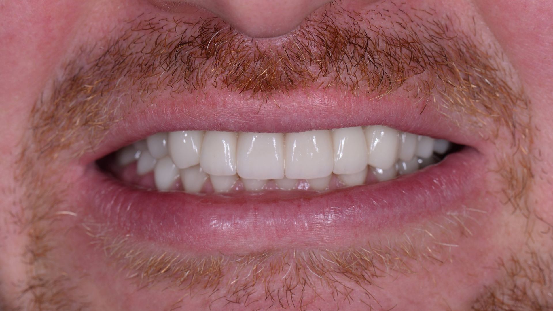 A close up of a man 's mouth with a beard and white teeth.