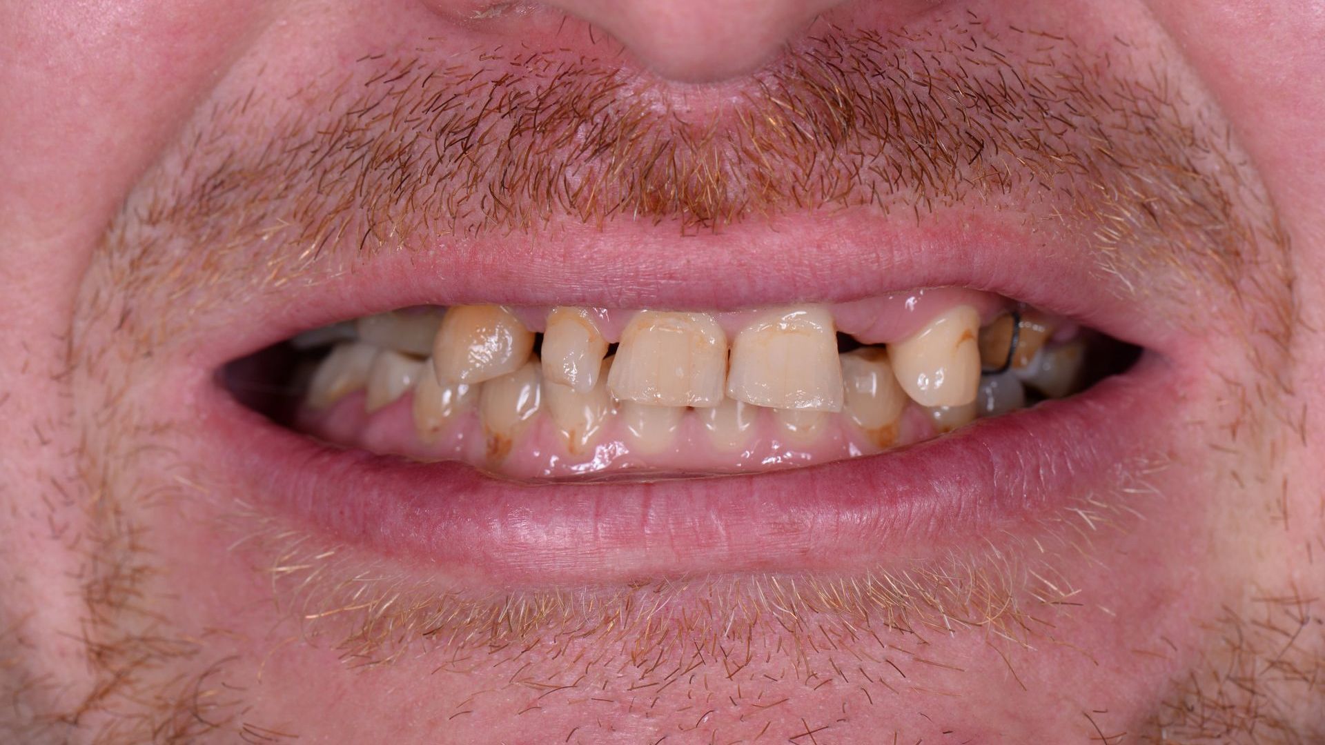 A close up of a man 's mouth with a beard and missing teeth.