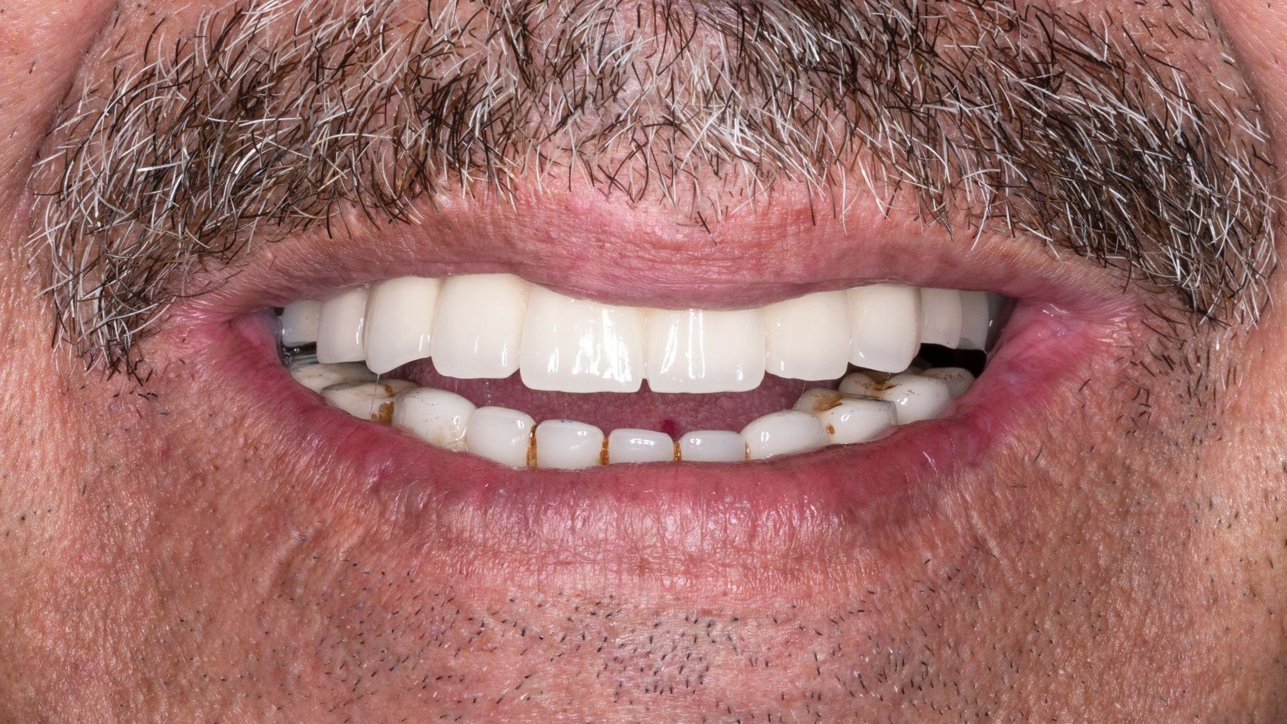 A close up of a man 's mouth with a beard and white teeth.