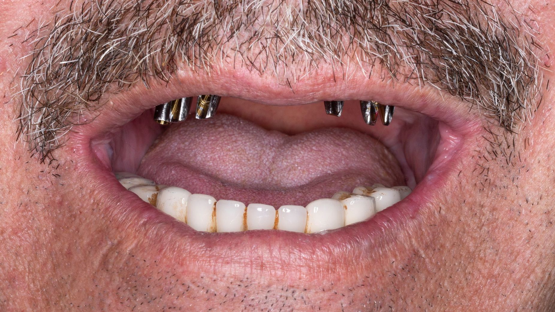 A close up of a man 's mouth with a beard and missing teeth.