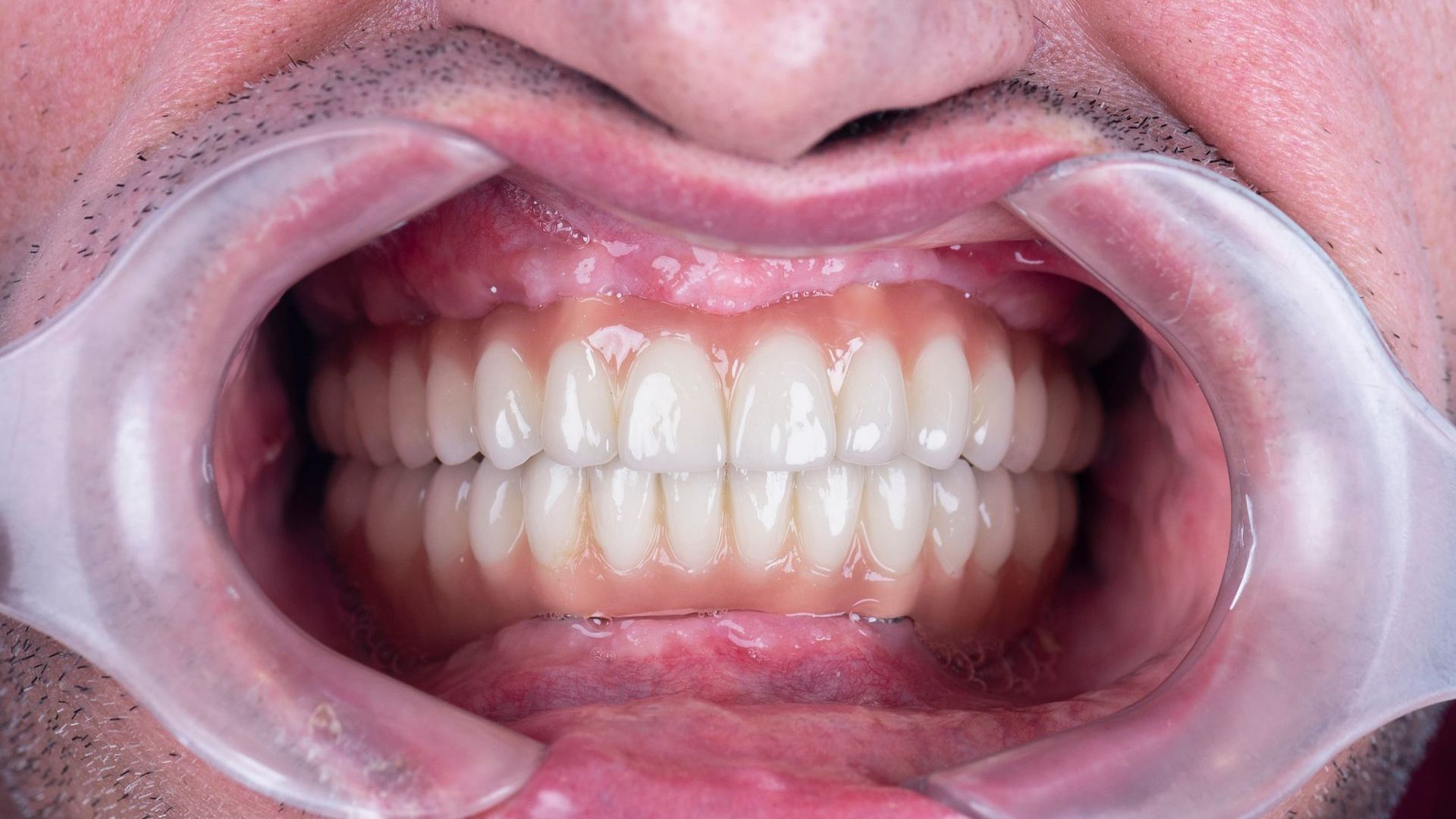 A close up of a man 's mouth with dental implants.