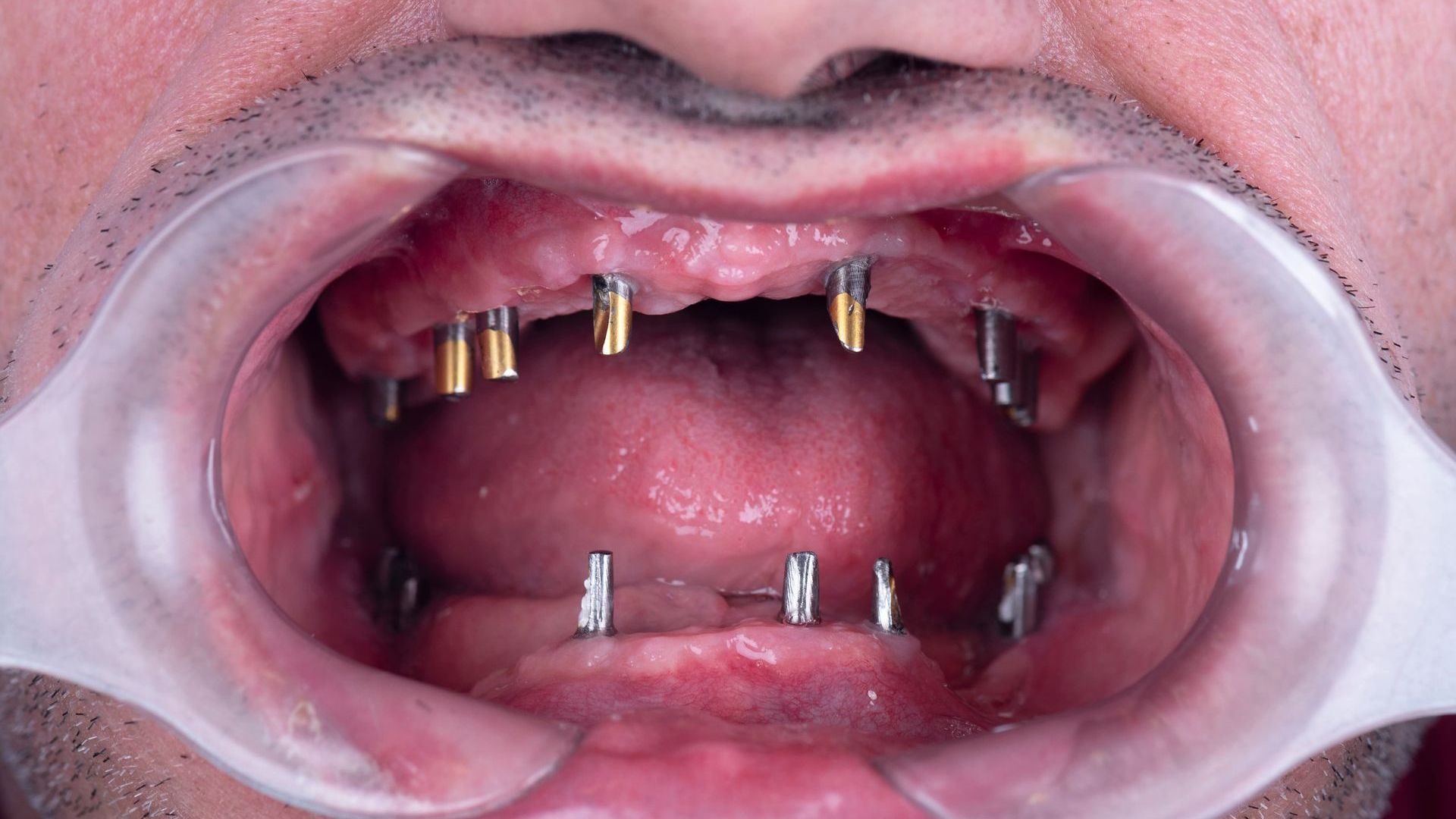 A close up of a man 's mouth with missing teeth.