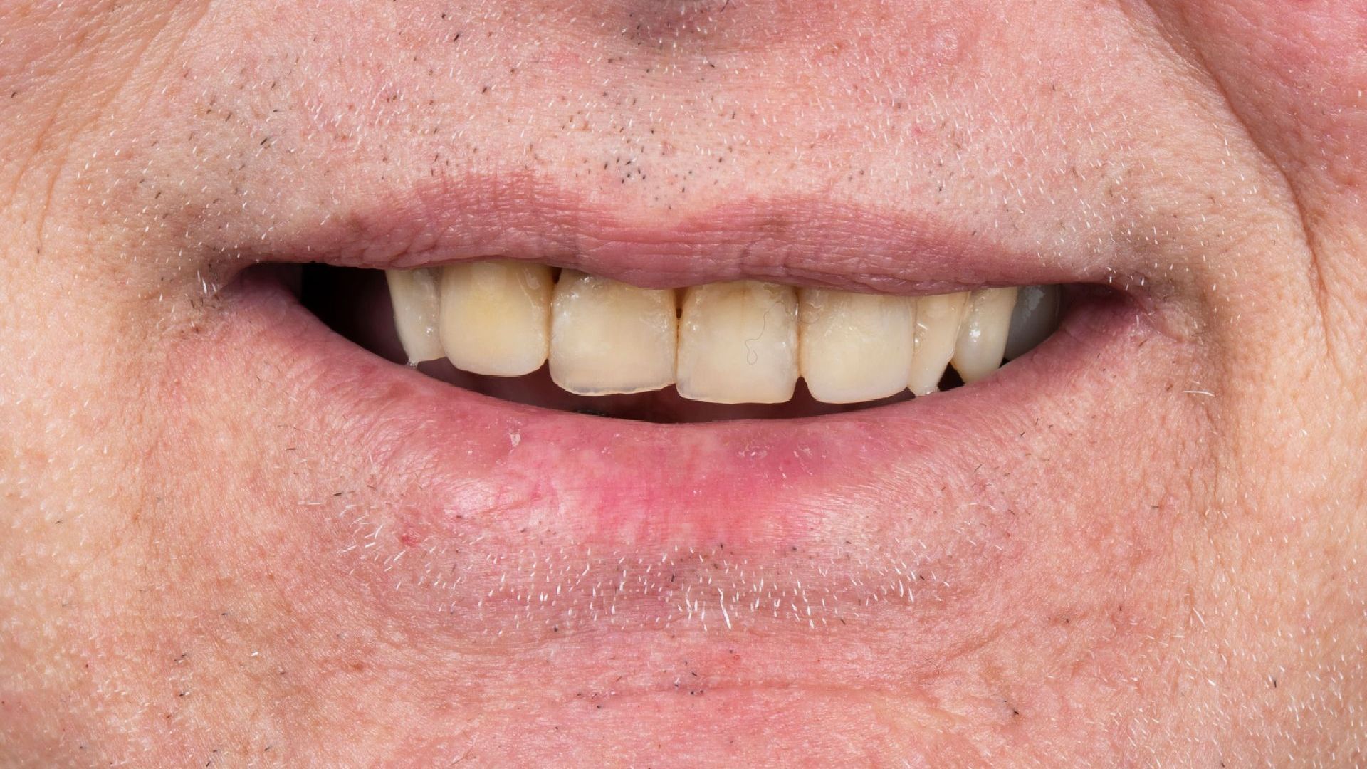 A close up of a man 's mouth with missing teeth.