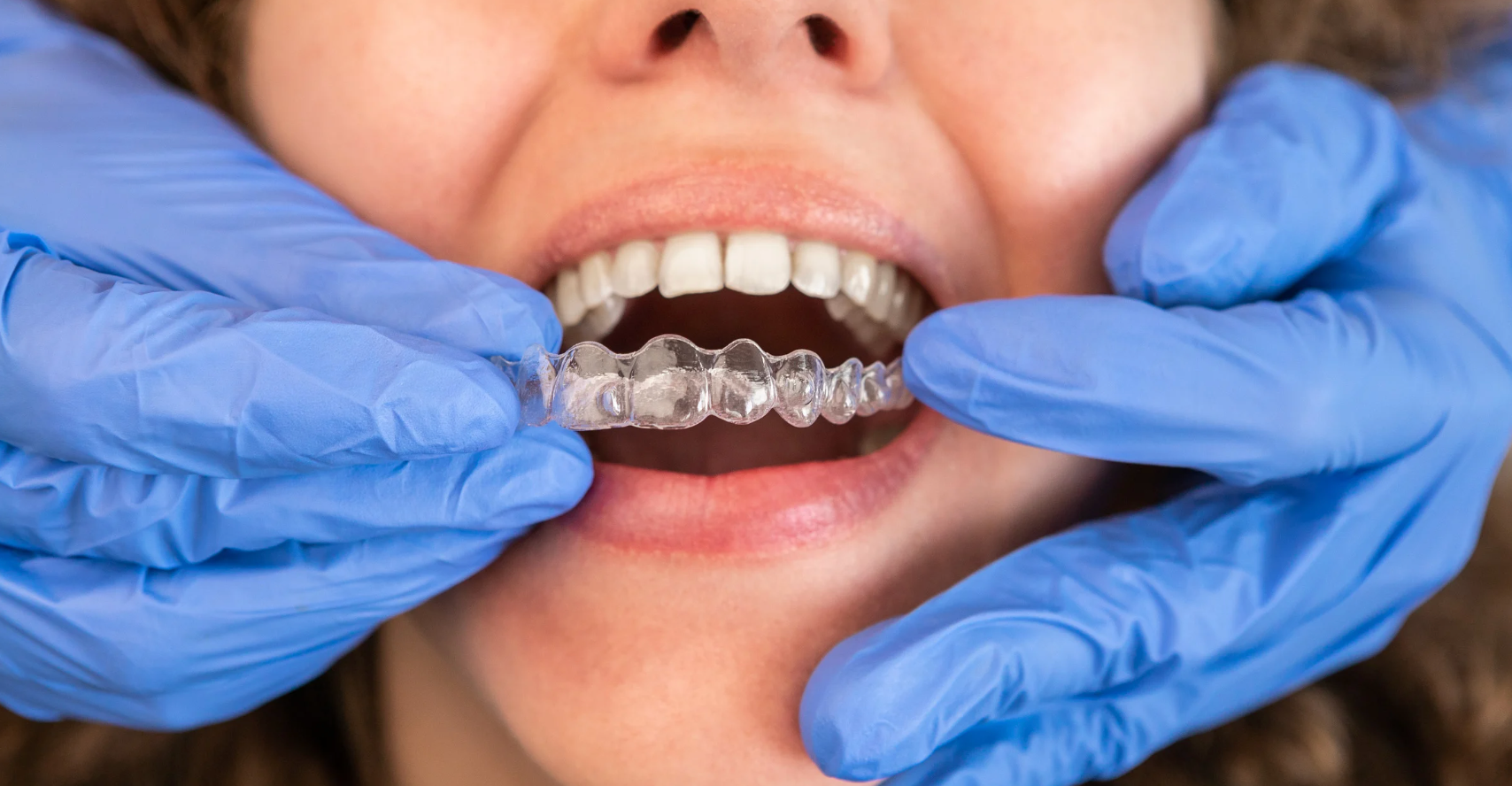 How Long Does Invisalign® Take?