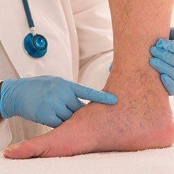 Vascular Surgery — Varicose Veins in Mission,TX