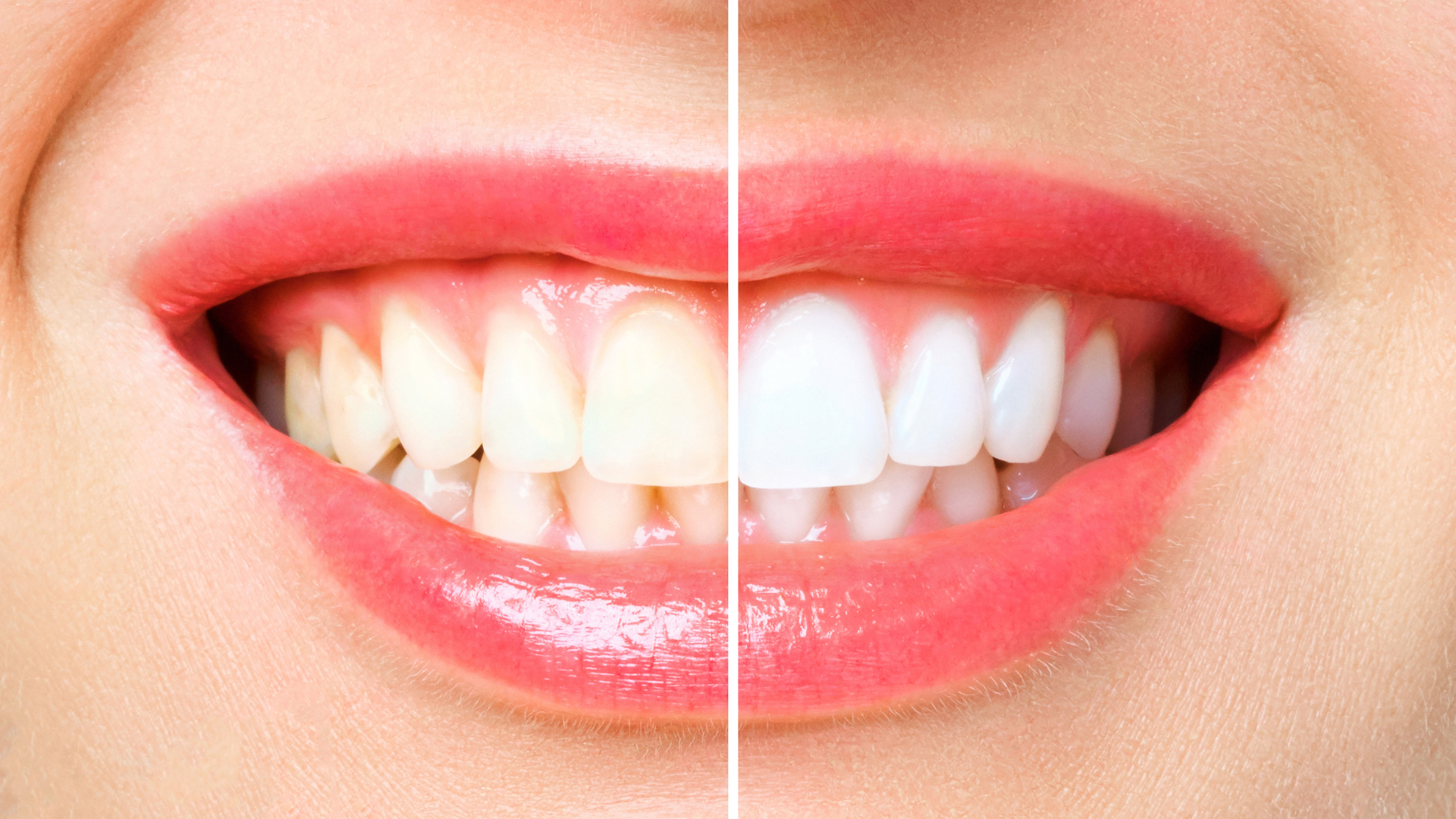 Smile showing a comparison of teeth before and after whitening, with pink lipstick.