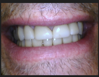 invisalign after image