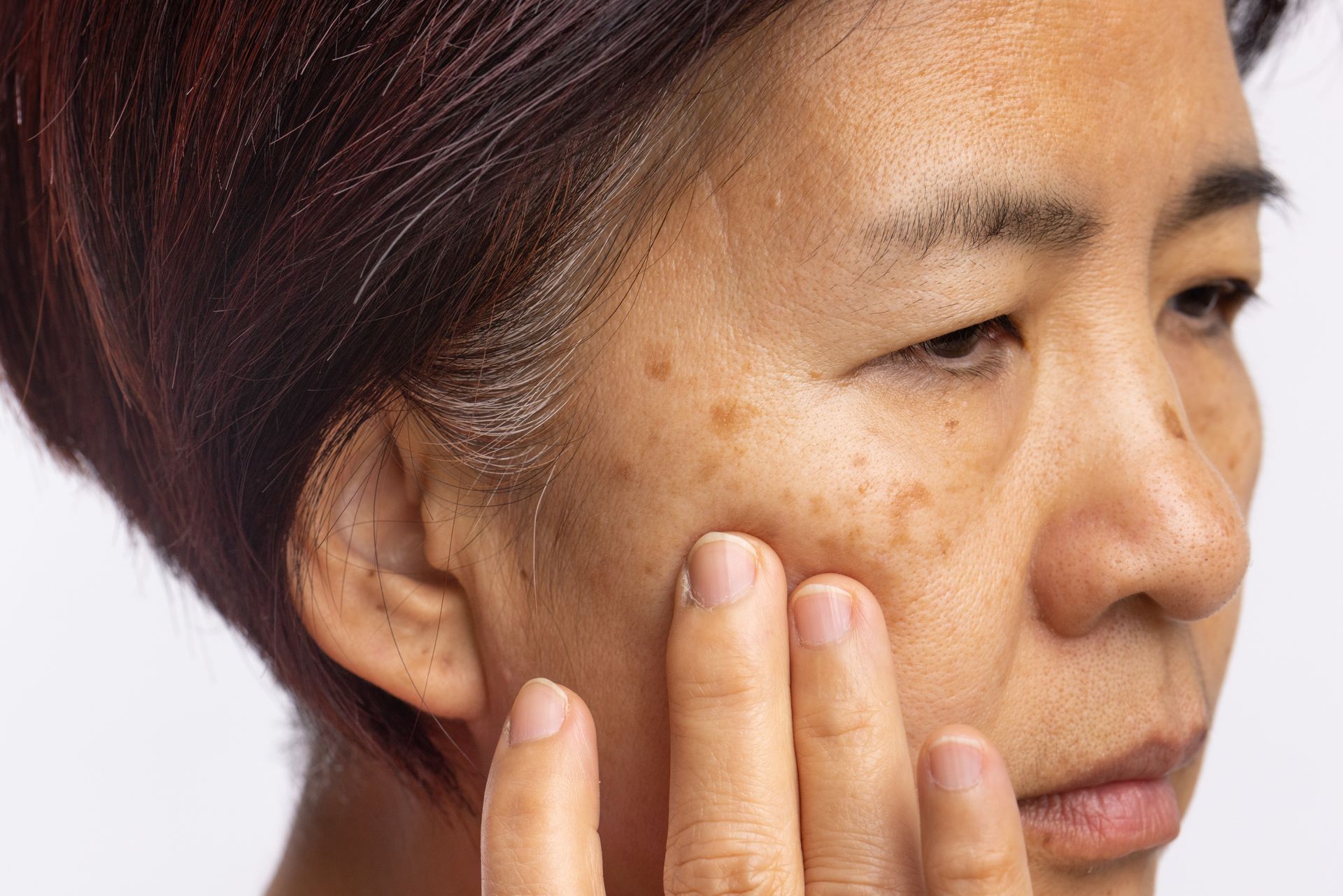 A close up of a woman 's face with spots on it.