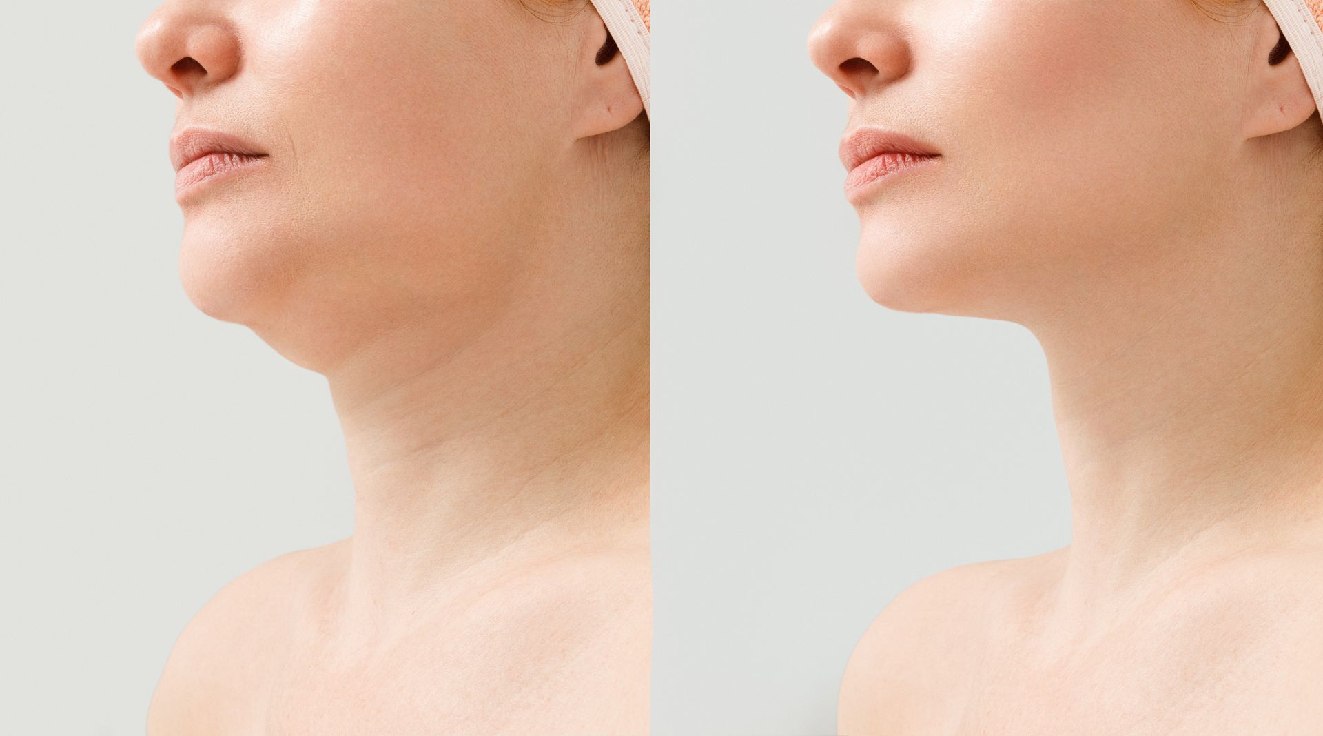 A before and after photo of a woman 's neck and chin.