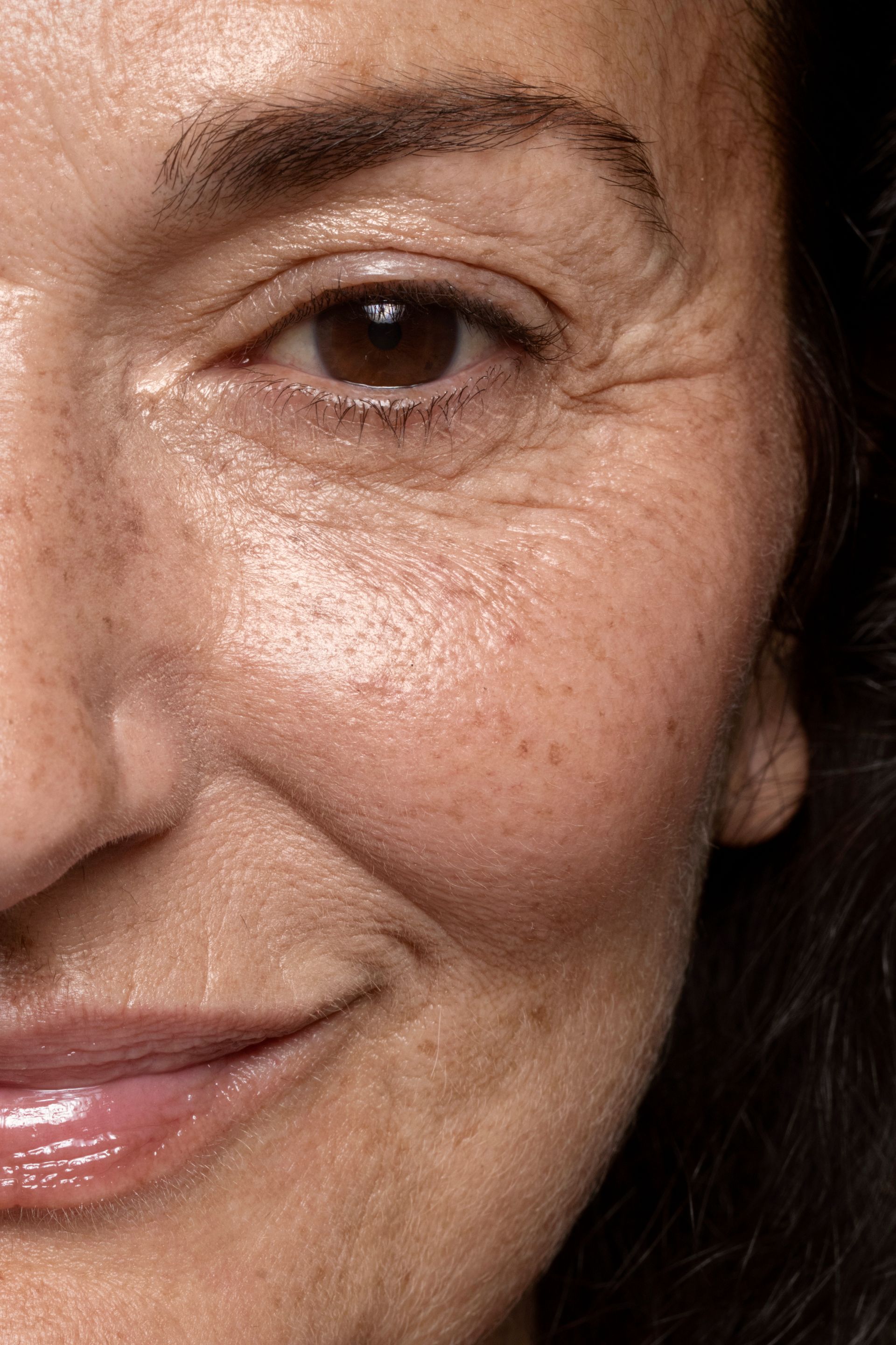 A close up of a woman 's face with brown spots on it.