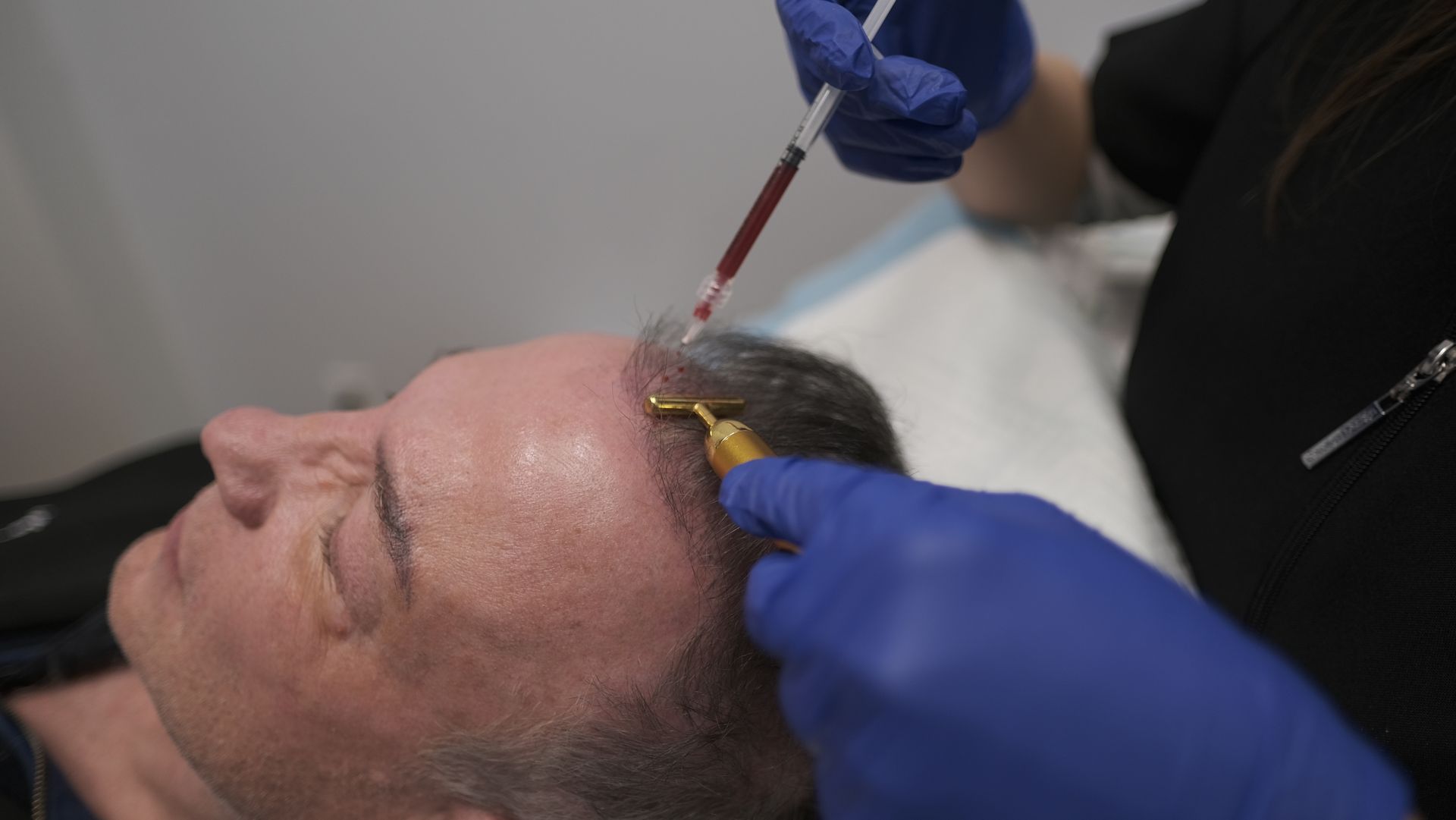 A man is getting a hair transplant in his forehead.