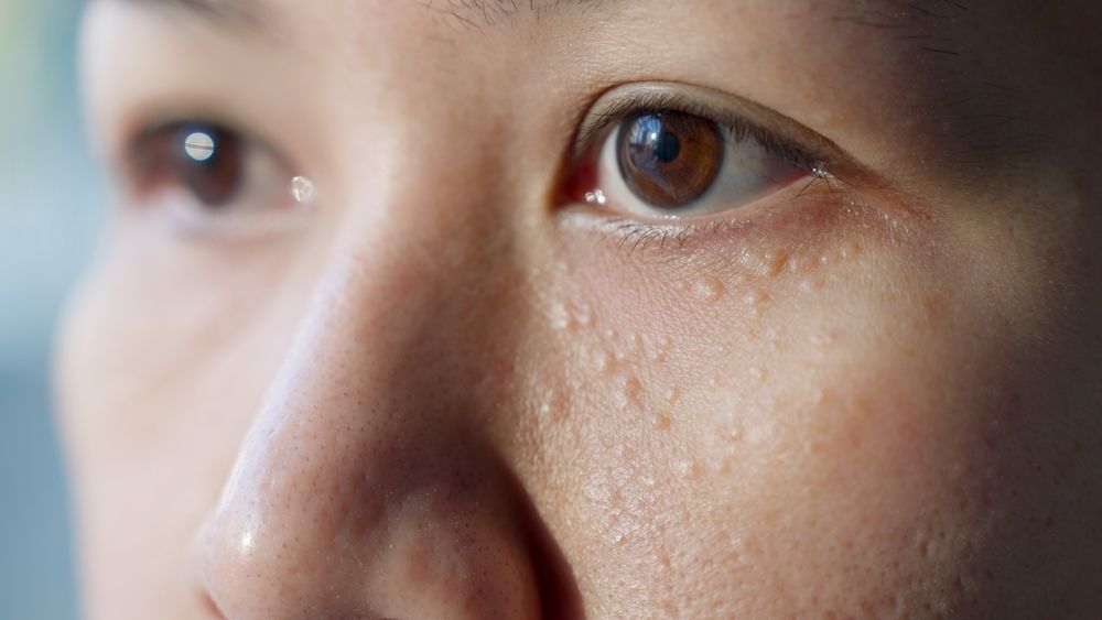 A close up of a woman 's eye with white spots on it.
