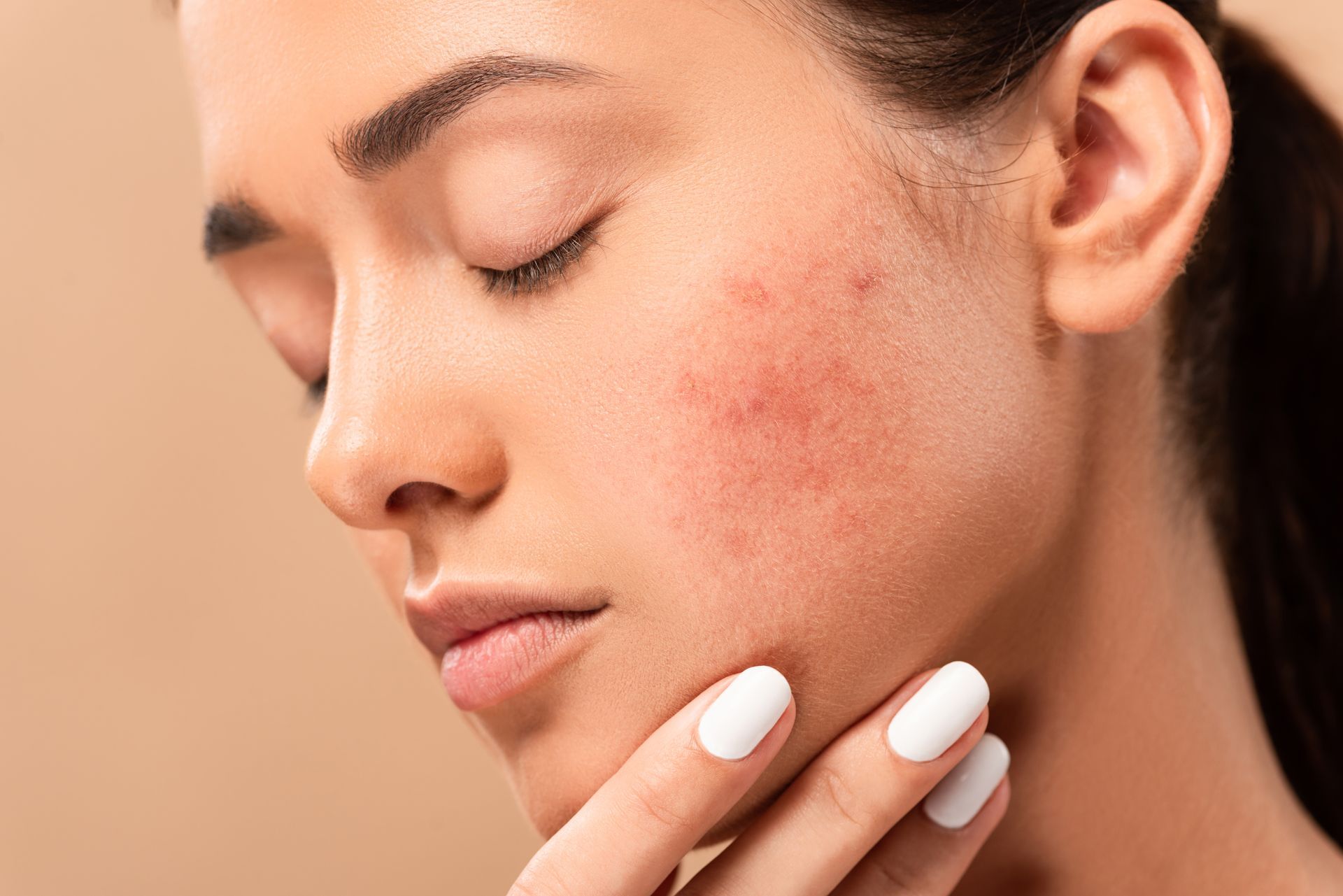 A woman with acne on her face is touching her face with her hand.