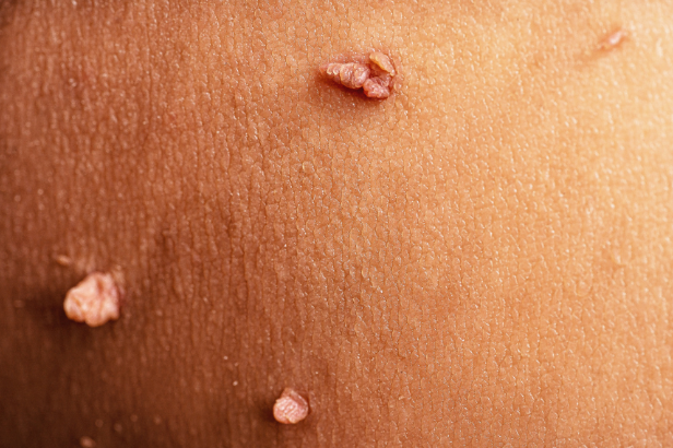 A close up of a person 's skin with warts on it.