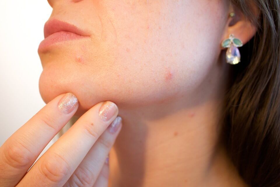 A close up of a woman 's face with acne and earrings.