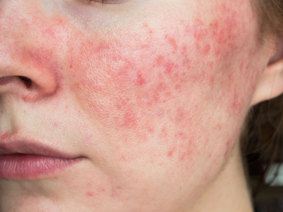 A close up of a woman 's face with red spots on it.