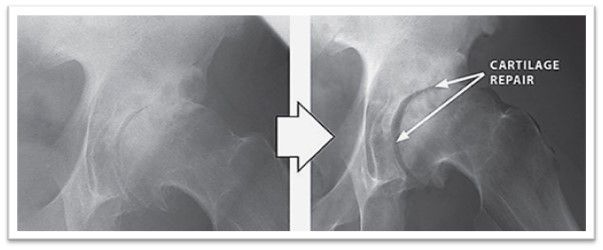 X-ray of knees before and after regenerative therapy treatments