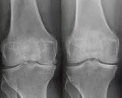 knees with arthritis before and after regenerative therapy