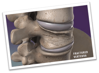 Vertebroplasty for spinal compression fracture