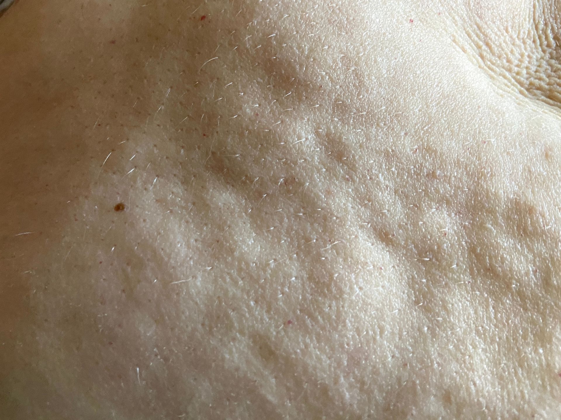 Fibrosis after lipo, bumps after liposuction, treatment of fibrosis San Francisco. fibrosis massage san Francisco bay area, treatment of fibrosis after lipo san francisco