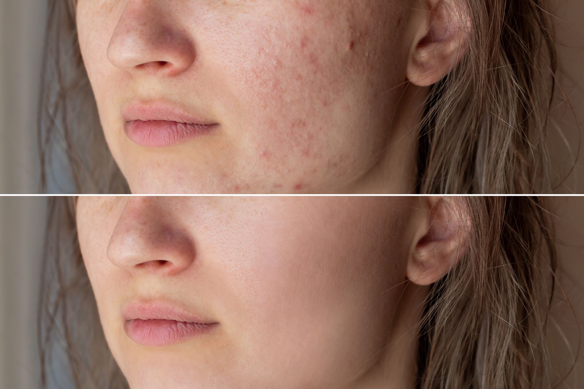 A before and after photo of a woman 's face with acne.