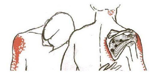 disegno di due persone con dolore alla spalla
