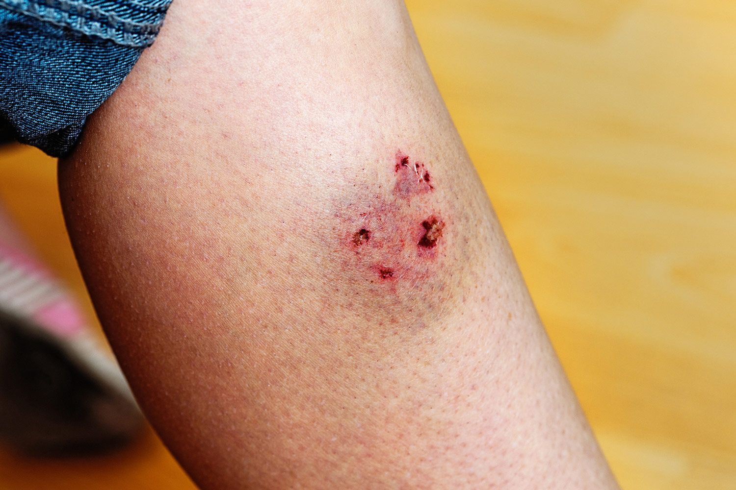 Animal bite on a person's leg