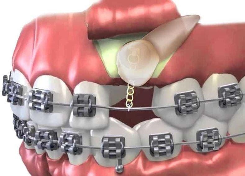 Surgical Exposure Surgery Oral and Maxillofacial Surgeons