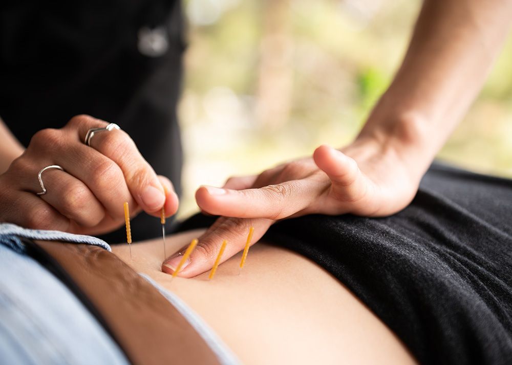 Dry Needling