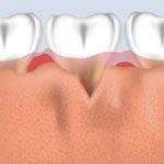 Transparent view of gums