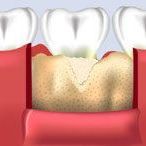 Area is filled with bone grafting material