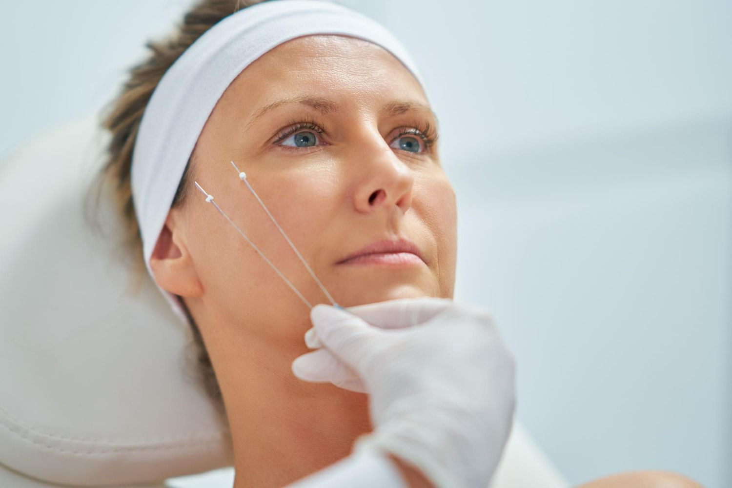 A woman is getting a thread lift on her face.