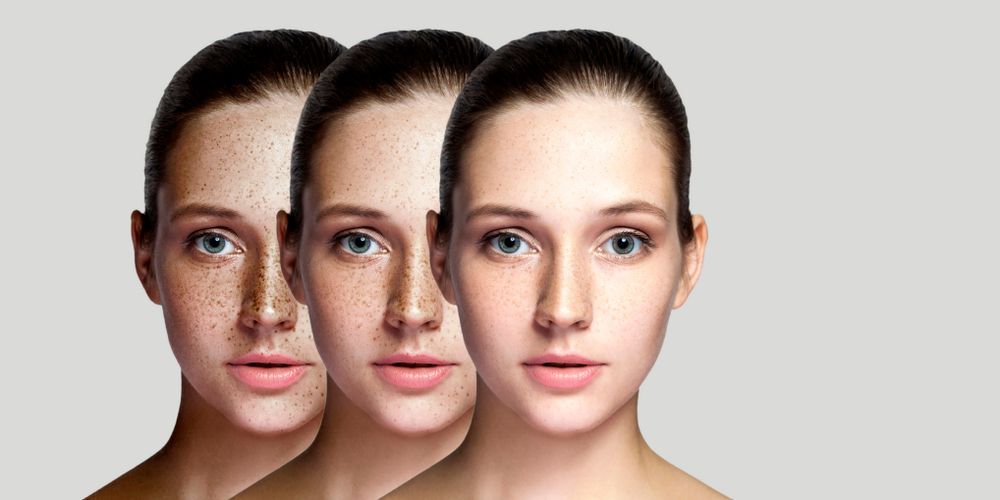 A woman 's face is shown before and after a treatment.
