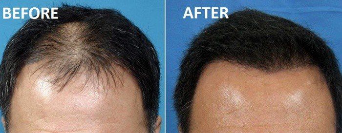 Before and after of hair restoration treatment