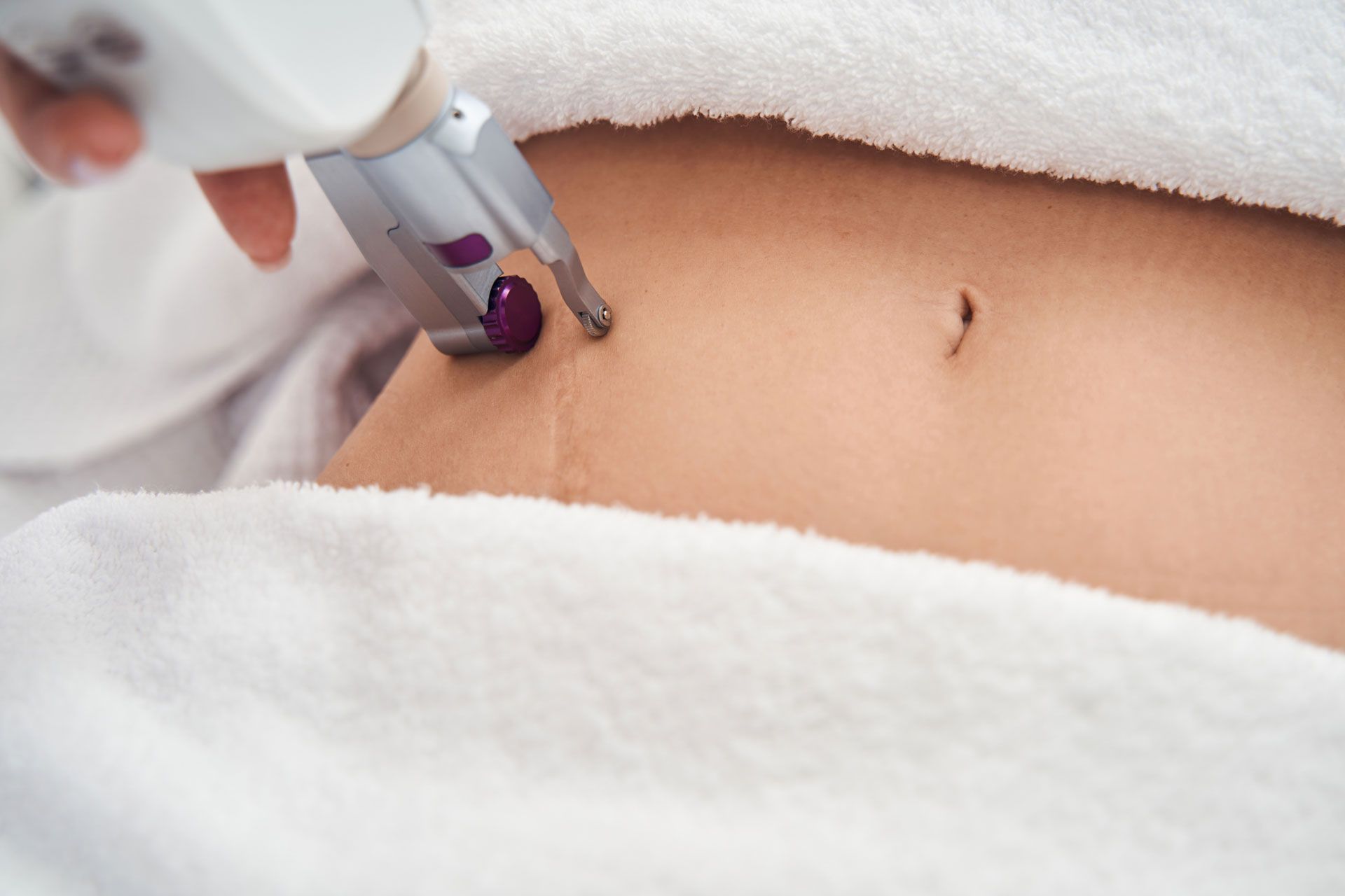 A medical device near a person's abdomen, on a white towel, likely for a cosmetic procedure.