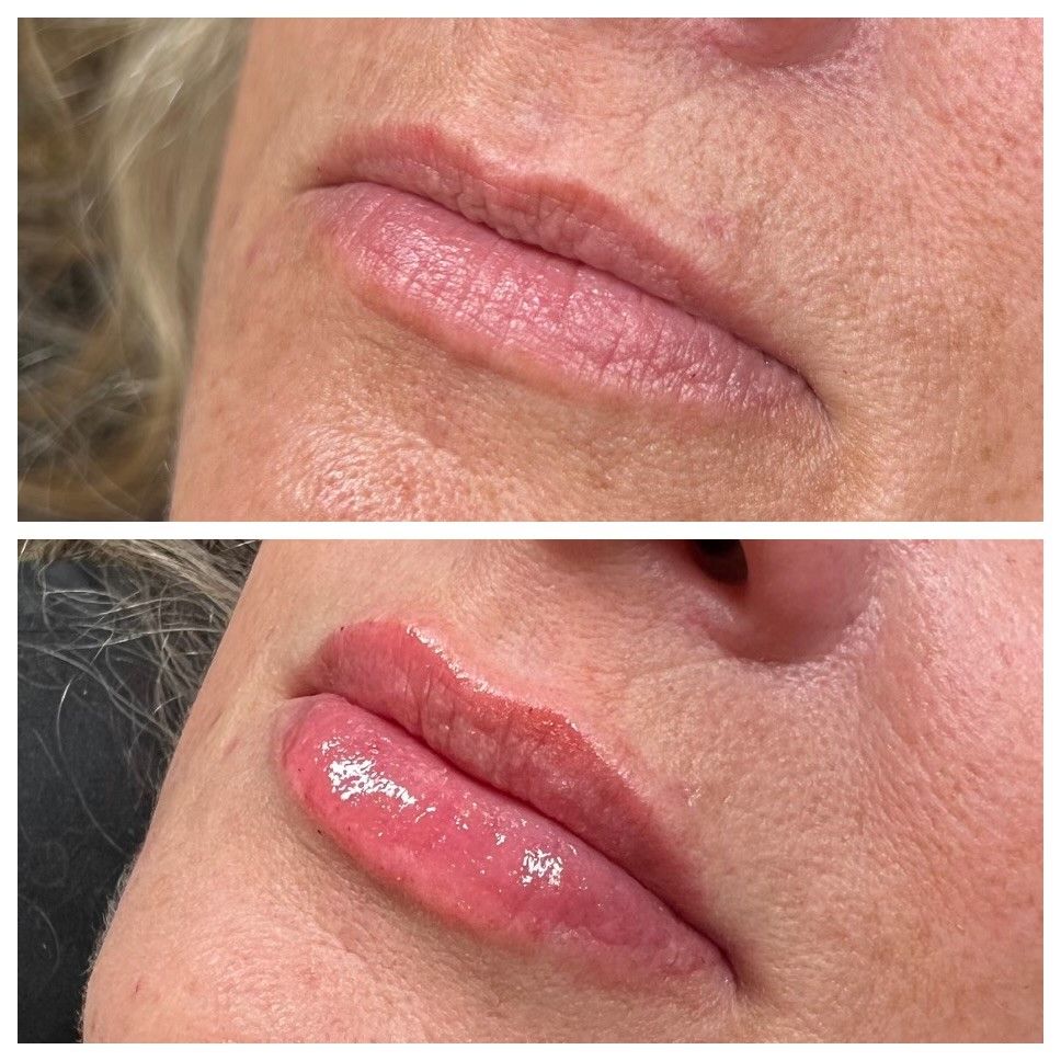 A before and after photo of a woman 's lips.