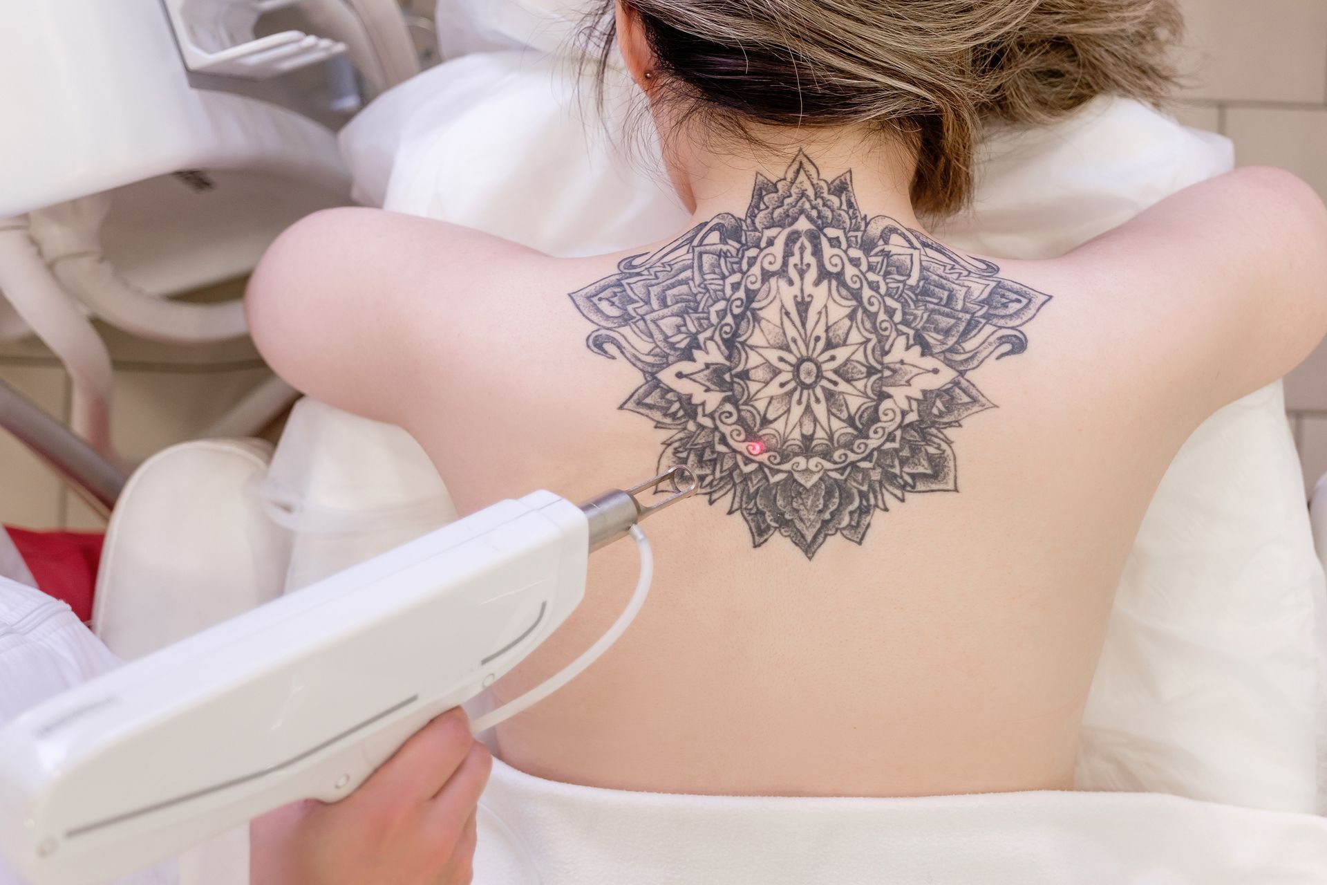 A woman is getting a tattoo removed from her back.