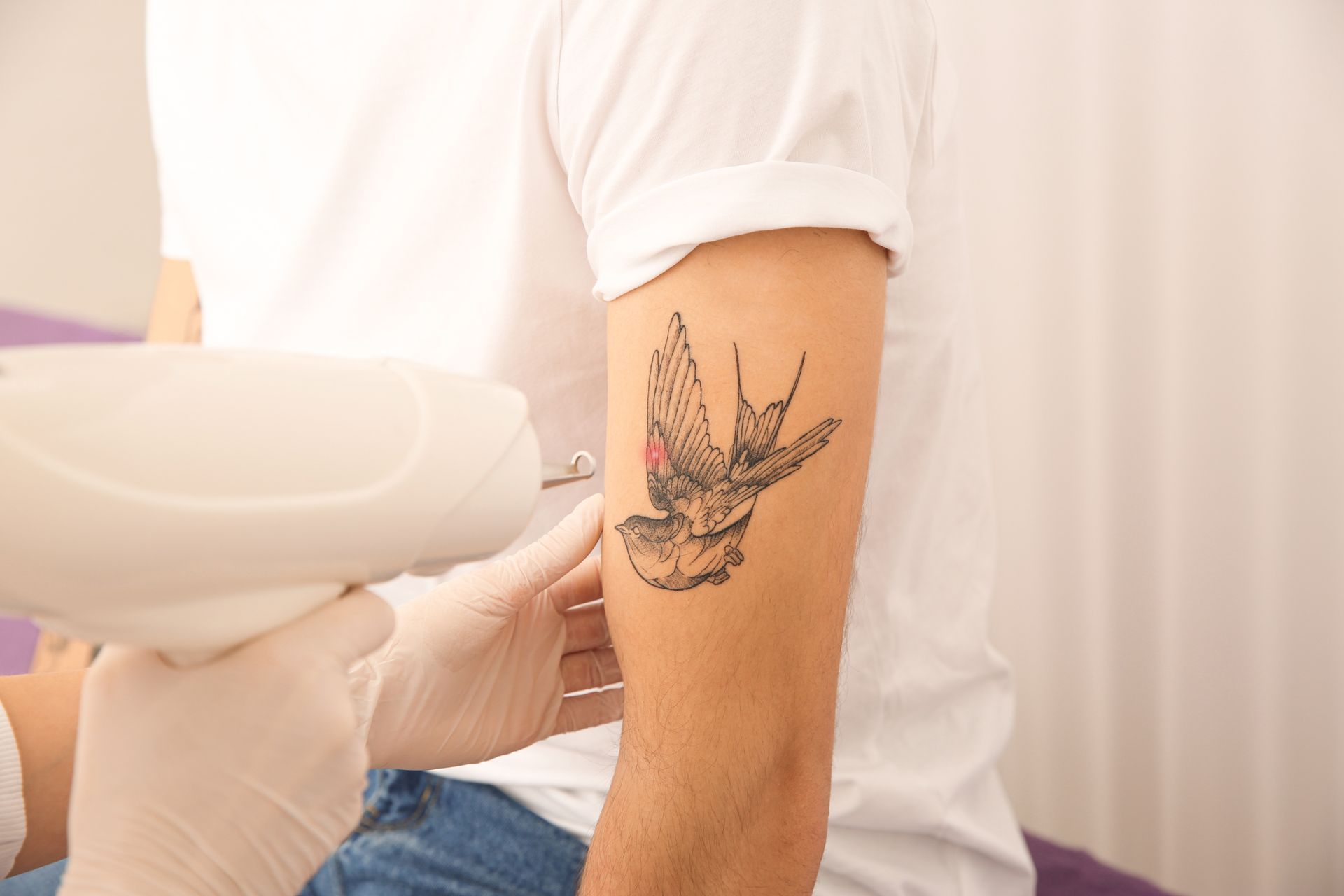 A man is getting a tattoo removed from his arm.