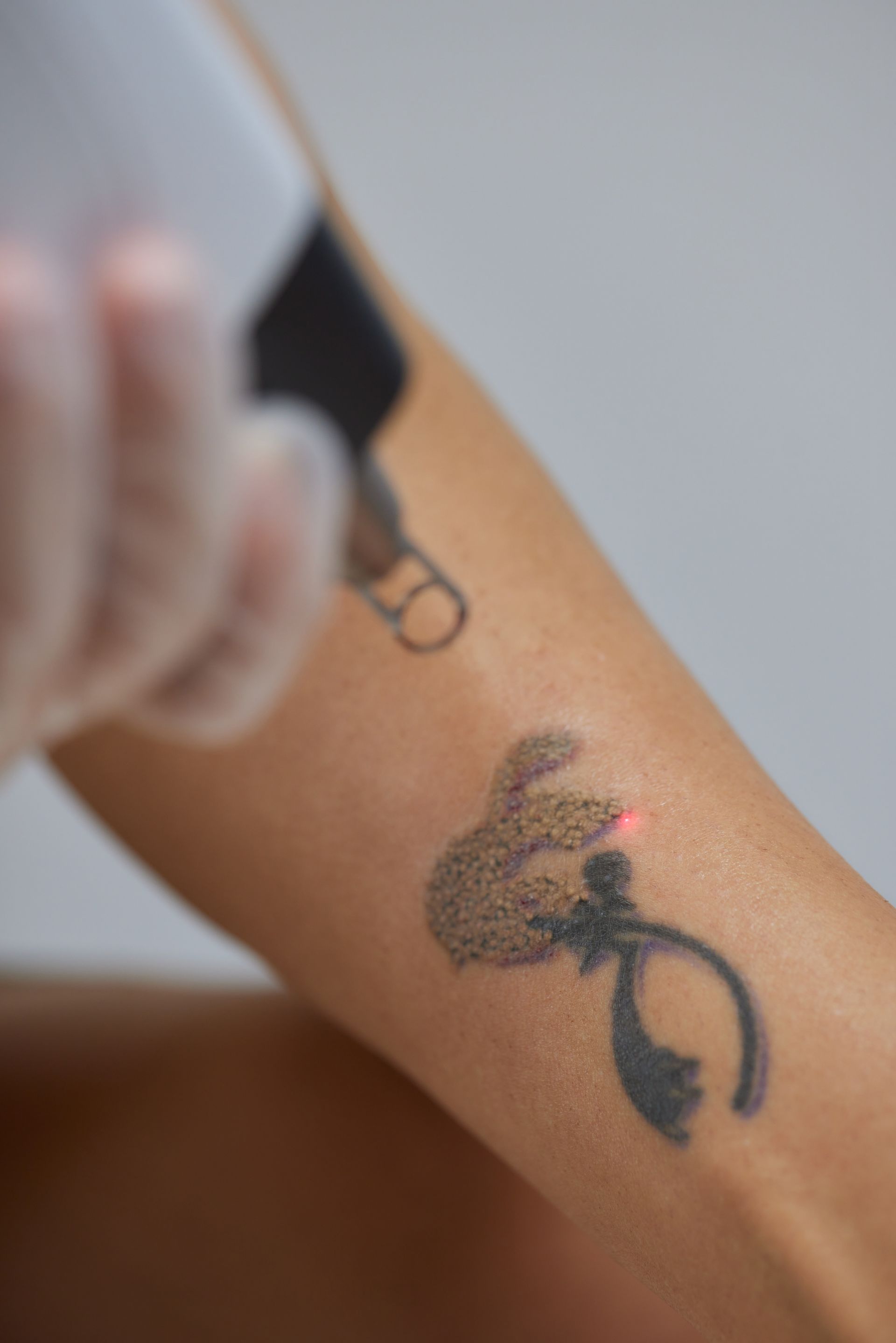 A person is getting a tattoo removed from their arm