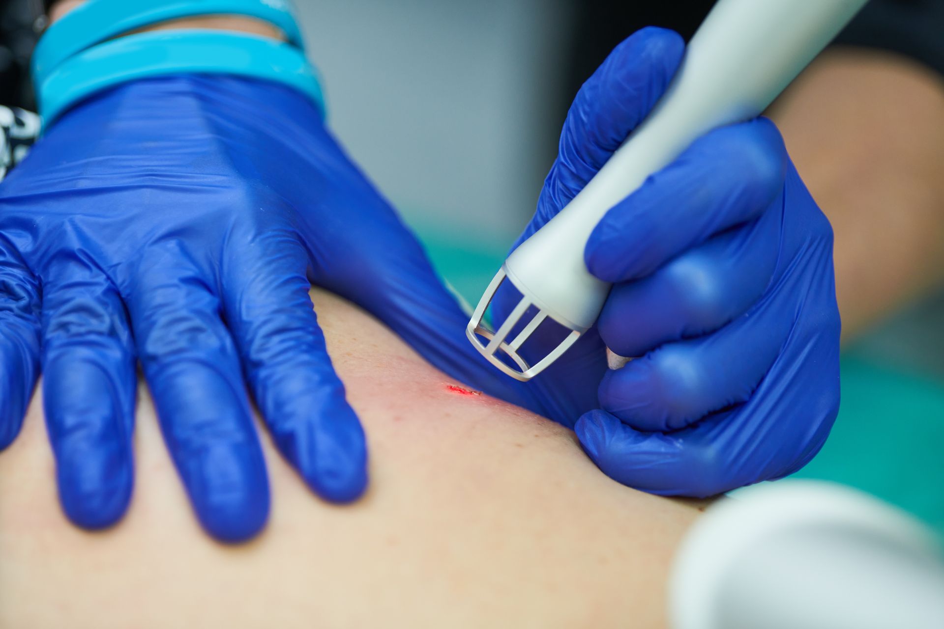 Gloved hands performing a skin examination with a handheld device on a person's back