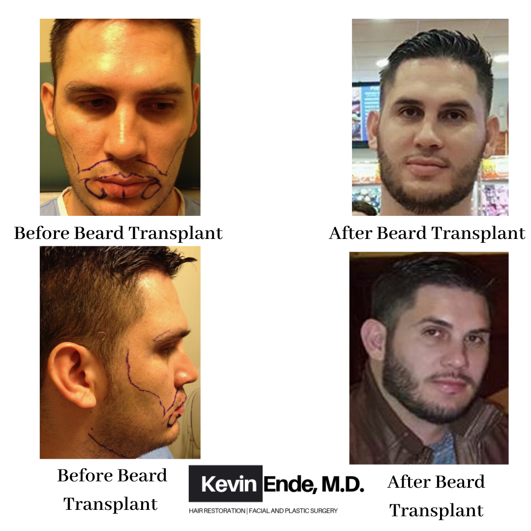 hair transplant