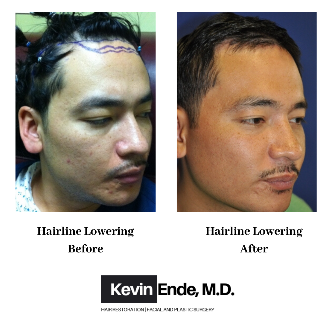 hair transplant