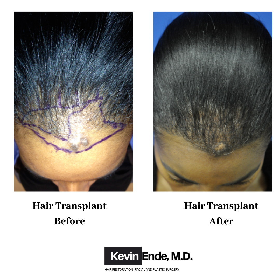 hair transplant