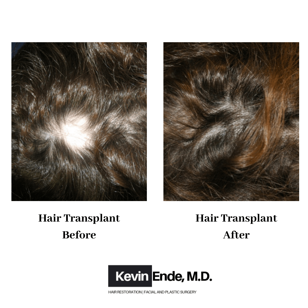 hair transplant