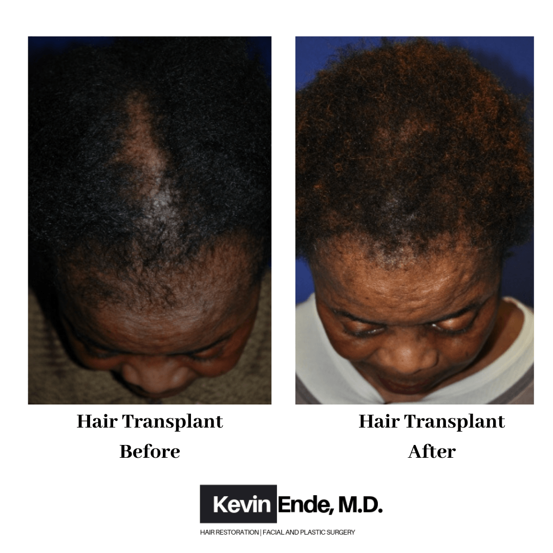 hair transplant