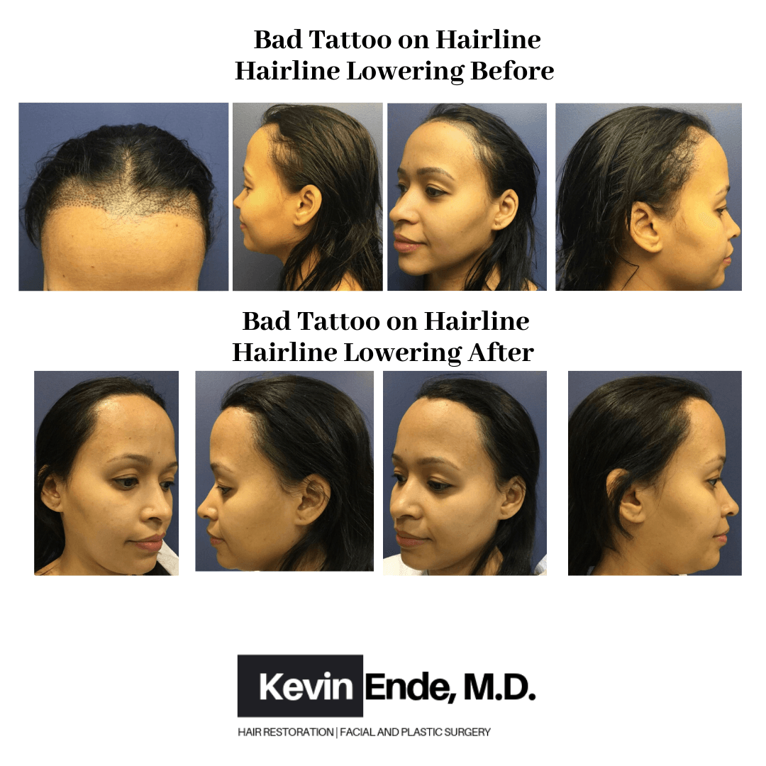 hair transplant